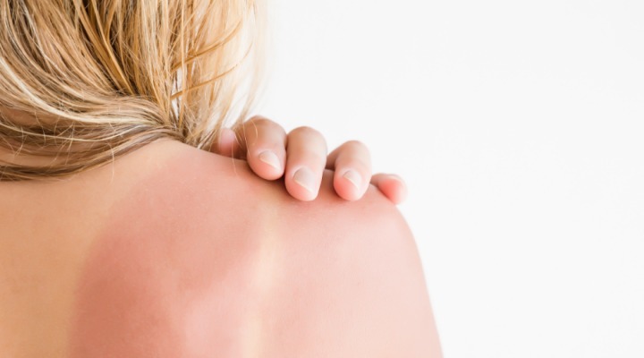 cbd balm for Sunburn relief